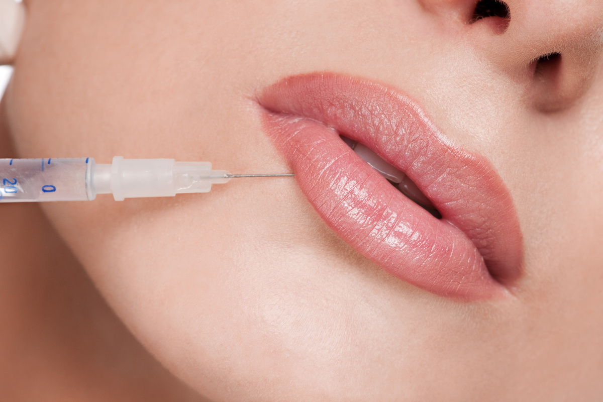 Estetska Hirurgija&Kozmetika - Povećanje usana - Problemi
